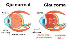 Cannabis y Glaucoma